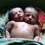 Weird but True: Two-Headed Baby born in Brazil!